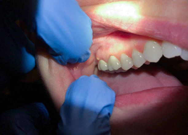 Best Emergency Treatment for Dental Infections or Abscesses in Broken Bow, NE